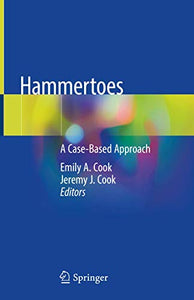 Hammertoes